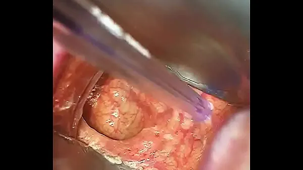 Melhores Cirurgia anal clipes de vídeos